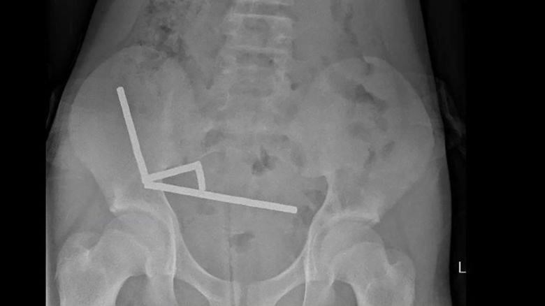 This undated handout released on October 24, 2025 from the New Zealand Medical Journal (NZMJ) shows an x-ray image of pieces of high-power magnets clumped up in the intenstines of a New Zealand teenager in Tauranga. A 13-year-old boy in New Zealand swallowed up to 100 high-power magnets he bought on Temu, forcing surgeons to remove tissue from his intestines, doctors said on October 24. After suffering four days of abdominal pain, the unnamed teen was taken to Tauranga Hospital on the North Island.