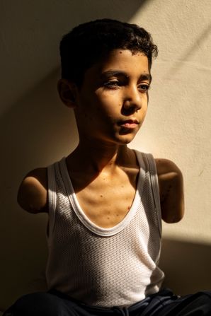 <strong>"Mahmoud Ajjour, Aged Nine."</strong> Mahmoud Ajjour, who was injured during an <a href="index.php?page=&url=https%3A%2F%2Fwww.cnn.com%2Fworld%2Fmiddleeast%2Fisrael">Israeli attack on Gaza City</a> in March 2024, finds refuge and medical help in Doha, Qatar, on June 28, 2024. Winner, World Press Photo of the Year.