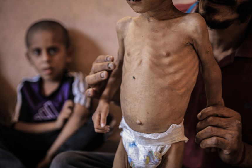 Two-year-old Yezen Abu Ful continues to lose weight as his condition worsens due to severe food shortages caused by the blockade and Israeli attacks, in Gaza City, Gaza on July 13.