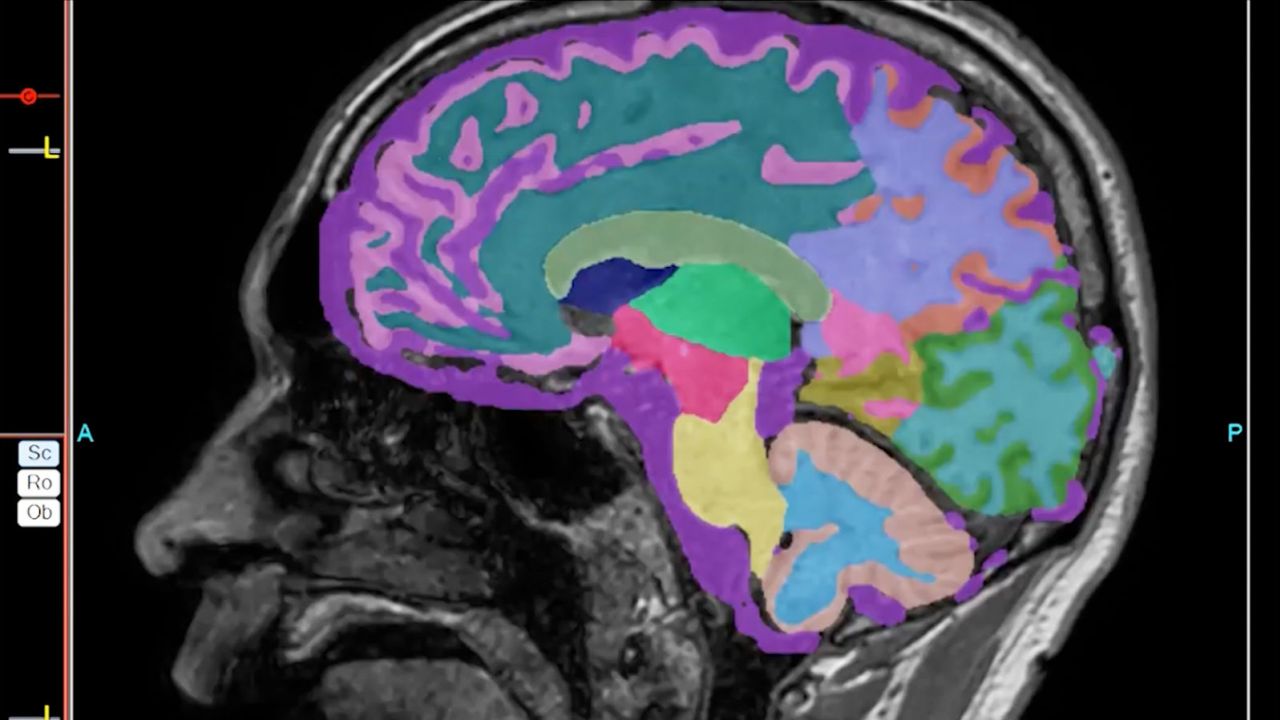 Brain scan from one of Dr. Richard Isaacson’s Alzheimer’s patients who has shown an improvement in brain volume.