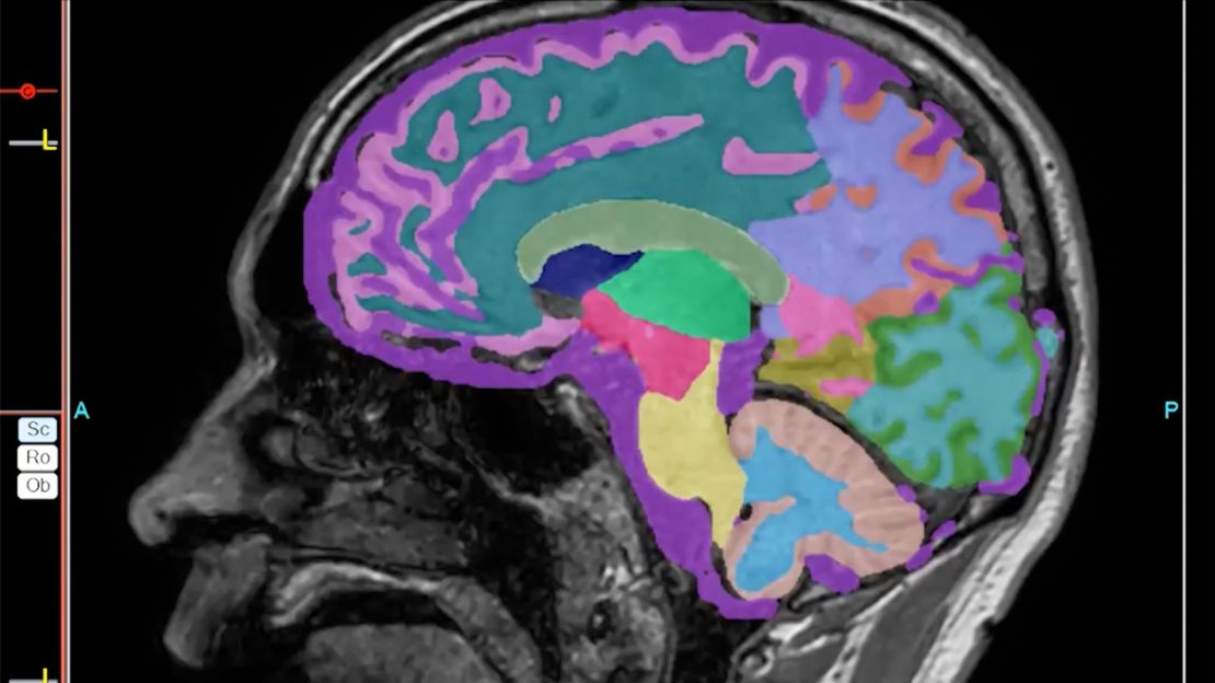 Brain scan from one of Dr. Richard Isaacson’s Alzheimer’s preventative neurology patients, a 55-year-old man with the highest known genetic risk for Alzheimer's. Through early intervention, he has shown improvement in brain volume.