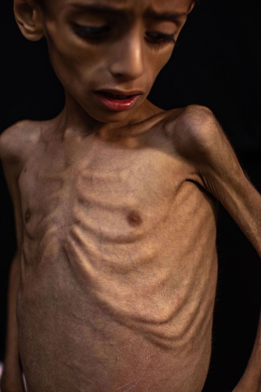 Five-year-old Osama al-Raqab, suffering from severe malnutrition, undergoes treatment at the Nasser Hospital in Khan Younis, Gaza, on Saturday, May 31. <a href="index.php?page=&url=https%3A%2F%2Fwww.cnn.com%2F2025%2F06%2F03%2Fmiddleeast%2Fgaza-aid-distribution-deadly-what-to-know-latam-intl">Israel halted all humanitarian aid into Gaza in early March</a>, with government officials saying their goal was to force Hamas to accept new ceasefire terms and release hostages taken during the militant group’s terror attack on Israel on October 7, 2023. The ban meant no supplies entered the territory for 11 weeks, pushing Gaza’s 2.1 million people deeper into a hunger crisis. Israel eased its blockade two weeks ago, allowing a small amount of aid to enter Gaza, but the amount of aid trickling in is nowhere near enough to meet the needs of the population, according to Palestinian officials and international aid groups.
