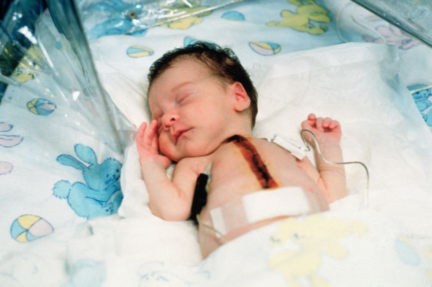 Dr. Leonard Bailey got special permission to transplant a baboon heart into Baby Fae in 1984.