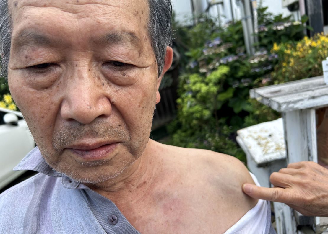 A neighbor points to the scar on 83-year-old Susumu Fujino’s shoulder that he received as a child when hit by shrapnel during the US firebombing of Kumagaya.