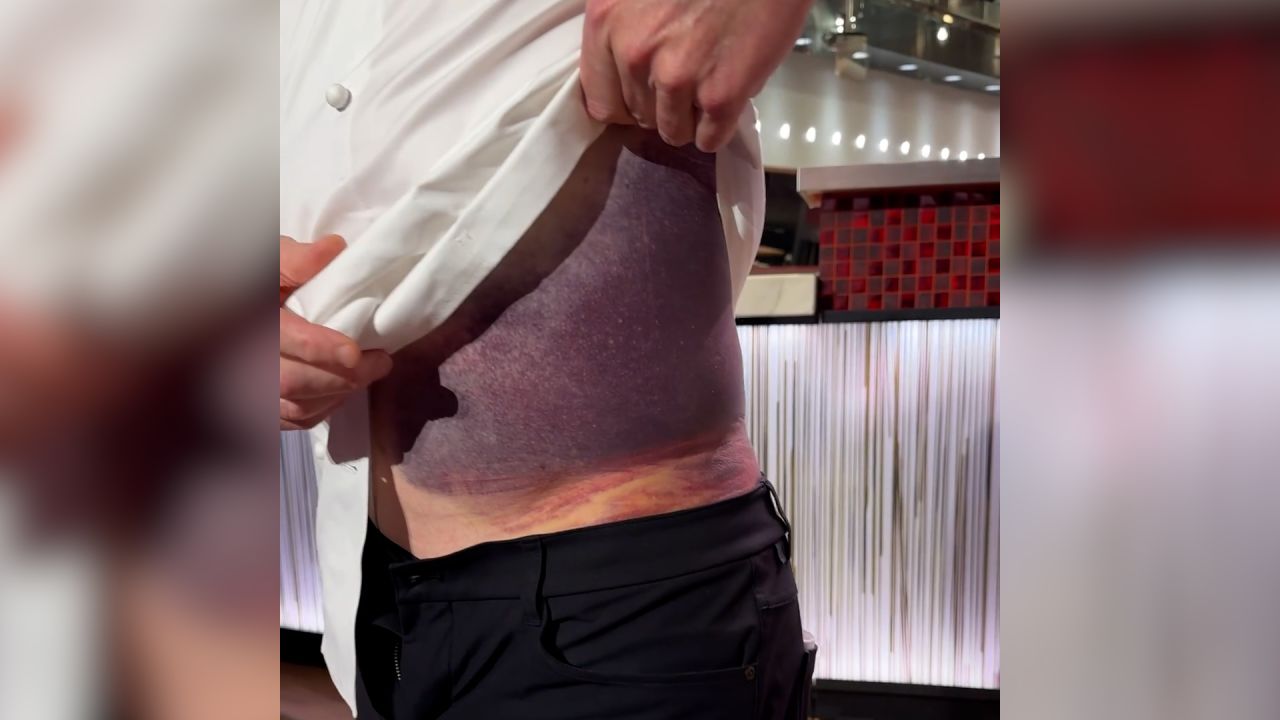 Video: Gordon Ramsay shows massive bruise after bike incident | CNN