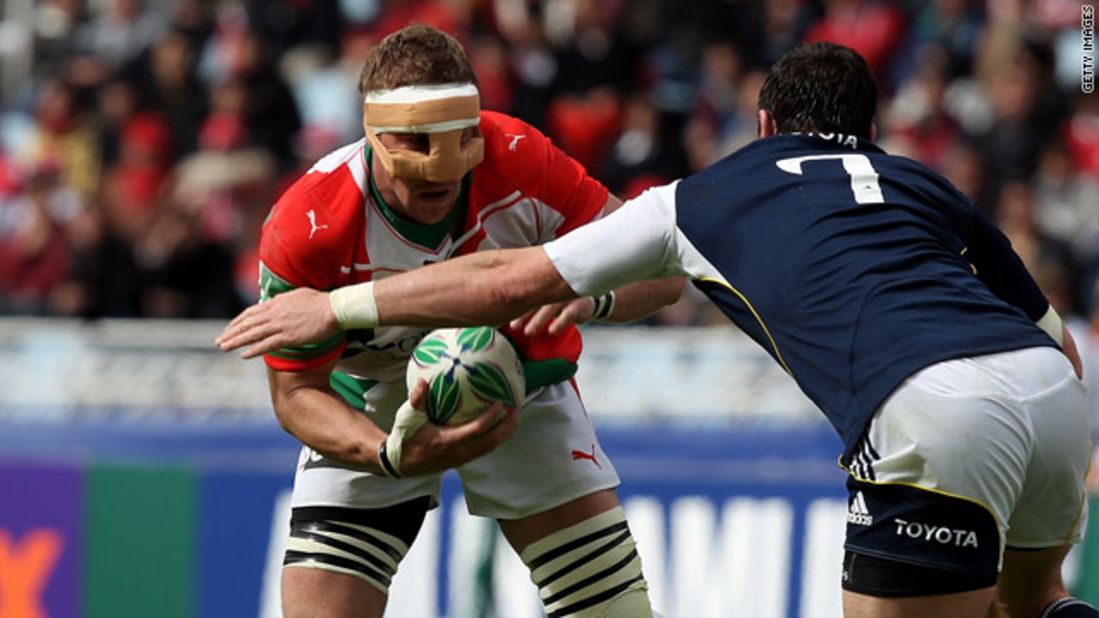 Biarritz and France No. 8 Imanol Harinordoquy played with a protector over his broken nose against Munster in a 2010 Heineken Cup semifinal match. 