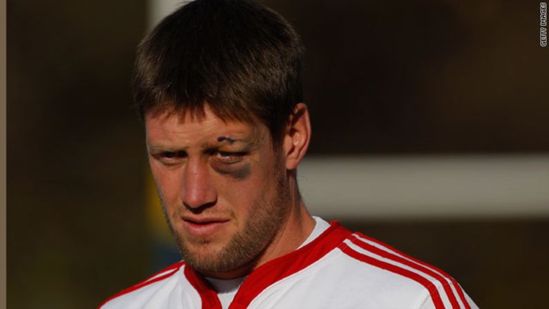 Ireland's Ronan O'Gara sports a classic shiner training with the British and Irish Lions in South Africa in 2009. The same player was on the receiving end of a furious attack from Australian Duncan McRae during a match in 2007.