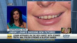 hln.lindsay.lohan.teeth_00002001