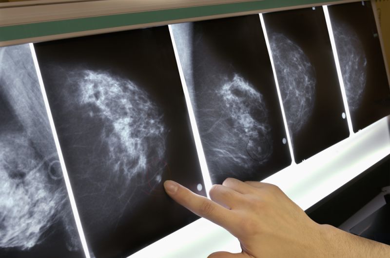 5 New Breast Cancer Discoveries | CNN