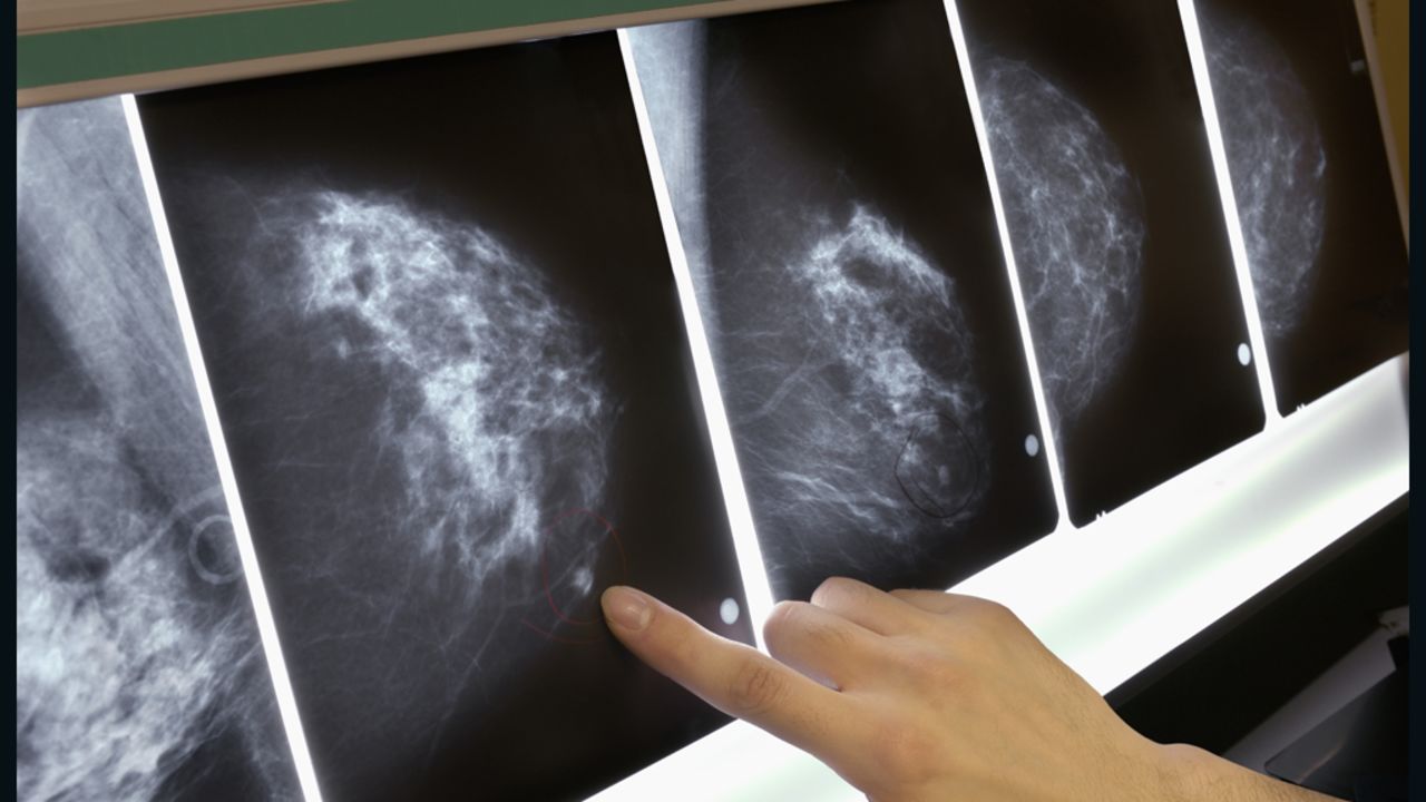 Women with annual mammograms are more likely to experience anxiety from false-positive results. 