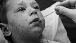 A four year-old boy with chicken pox has his temperature taken, circa 1955. 