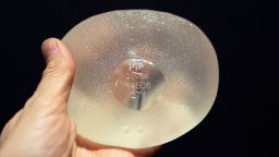 A breast implant produced by PIP (Poly Implant Prothese) company after a surgical operation.