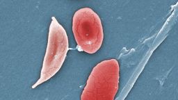 2009: This digitally-colorized scanning electron micrograph (SEM) revealed some of the comparative ultrastructural morphology between normal red blood cells (RBCs), and a sickle cell RBC (left) found in a blood specimen of an 18 year old female patient with sickle cell anemia, (HbSS); People who have this form of sickle cell disease inherit two sickle cell genes (âSâ), one from each parent. This is commonly called âsickle cell anemiaâ, and is usually the most severe form of the disease. Sickle cell disease is a group of inherited red blood cell disorders. Healthy red blood cells are round, and they move through small blood vessels to carry oxygen to all parts of the body. In sickle cell disease, the red blood cells become hard and sticky and look like a C-shaped farm tool called a ?sickle?. The sickle cells die early, which causes a constant shortage of red blood cells. Also, when they travel through small blood vessels, they get stuck and clog the blood flow. This can cause pain and other serious problems.