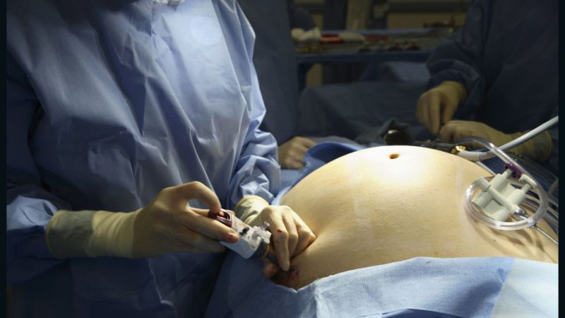 Doctor Q&A: Is Heart Surgery Safe for Obese Patients?