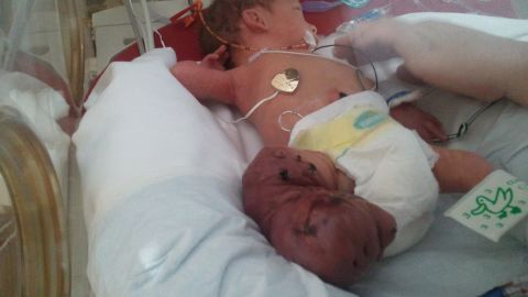 The swelling in Brantley's leg increased after birth.