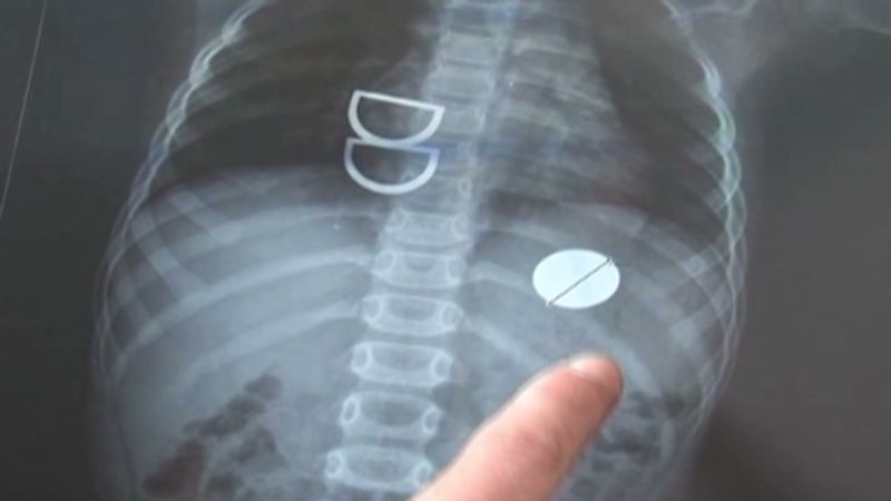 Doctors remove boy s swallowed coin