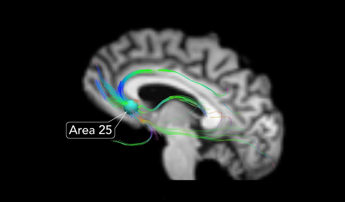 Area 25 is the junction of all brain circuits that control our moods, according to neurologist Dr. Helen Mayberg.