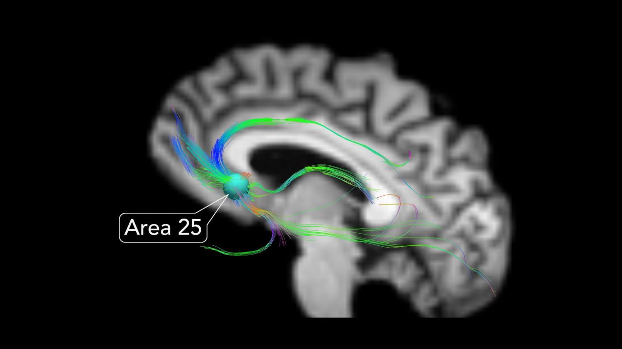 Area 25 is the junction of all brain circuits that control our moods, according to neurologist Dr. Helen Mayberg.