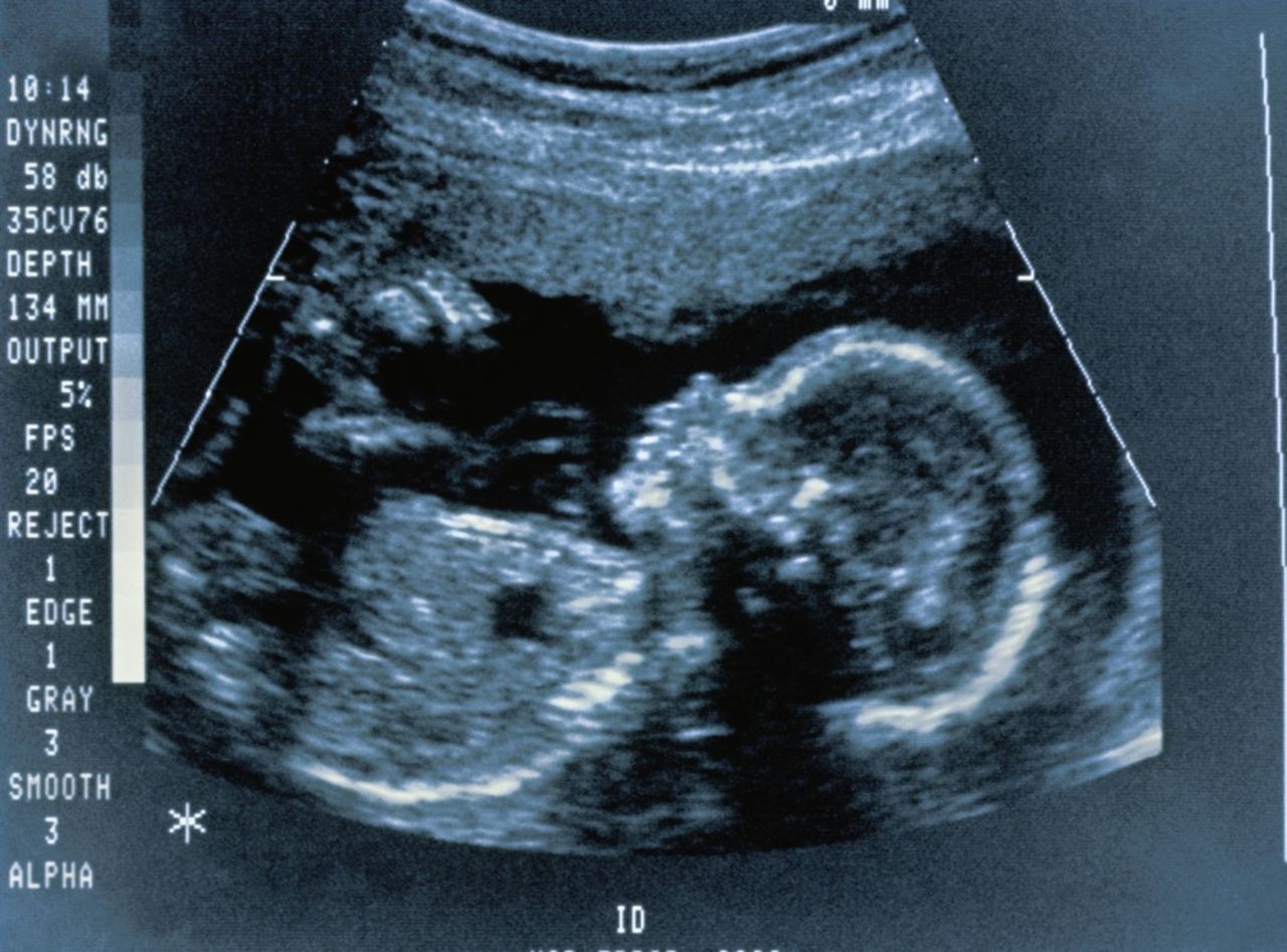 Пол ребенка фото на 12 неделе беременности фото