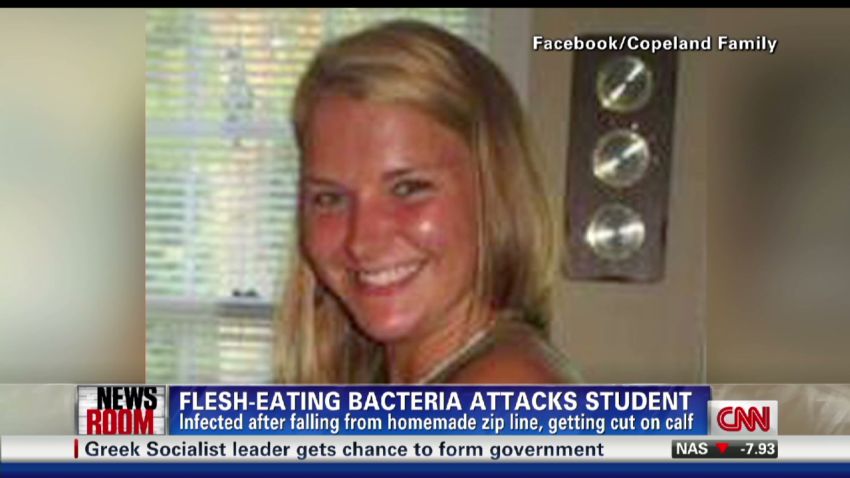 exp Cohen and woman infected with flesh-eating bacteria_00001701