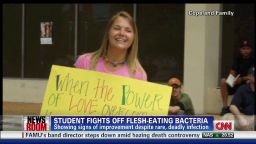 exp Flesh-Eating Bacteria Could Claim Student's Hands, Remaining Foot_00002001