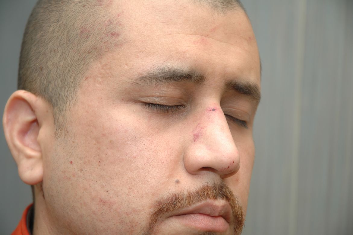 According to a fire department report, Zimmerman had "abrasions to his forehead," "bleeding/tenderness to his nose" and a "small laceration to the back of his head" when he was treated at the scene.