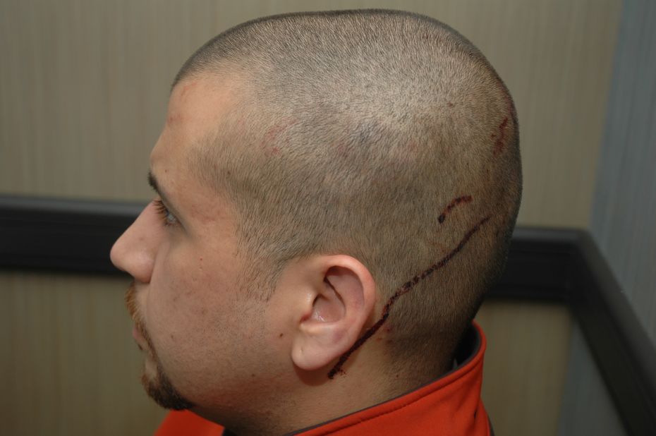 Zimmerman said that before he shot the teenager, he was "assaulted (by Martin) and his head was struck on the pavement," according to a police report.