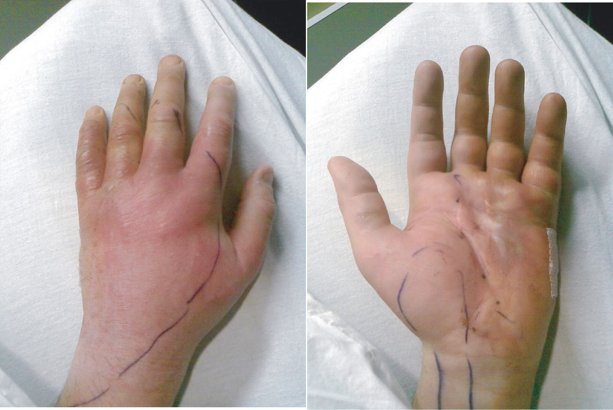 necrotizing fasciitis hand