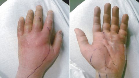 Percy von Lipinski's left hand looked like this as he recovered; the pen marks show the spread of infection.