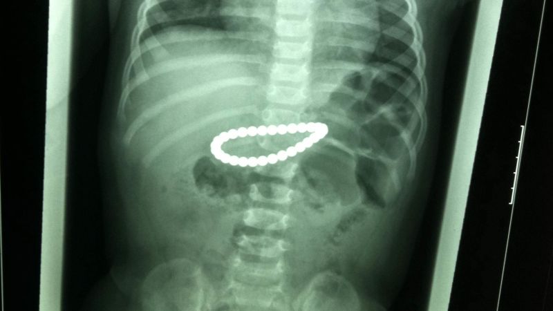 Little magnets are a big health hazard when swallowed