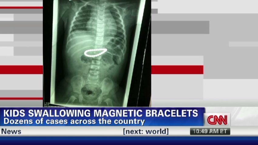 exp Swallowed magnets ruin child's intestine_00000620