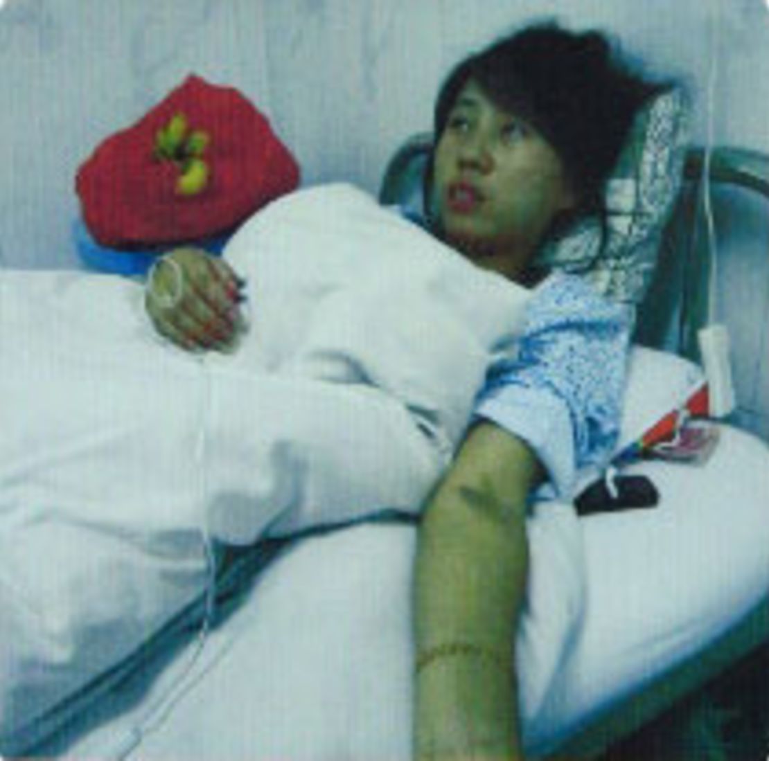 Chinese mother Feng Jianmei after her abortion operation.