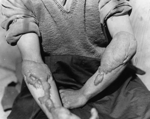 A victim of the American atomic bombing of Hiroshima, Japan, on August 6, 1945, shows the burns on his arms. The bombing of Hiroshima and Nagasaki effectively ended the Second World War.