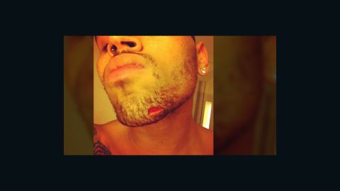 Chris Brown posted a photo of his injury, which appeared to be a half-inch gash on the left corner of his chin, on Instagram.