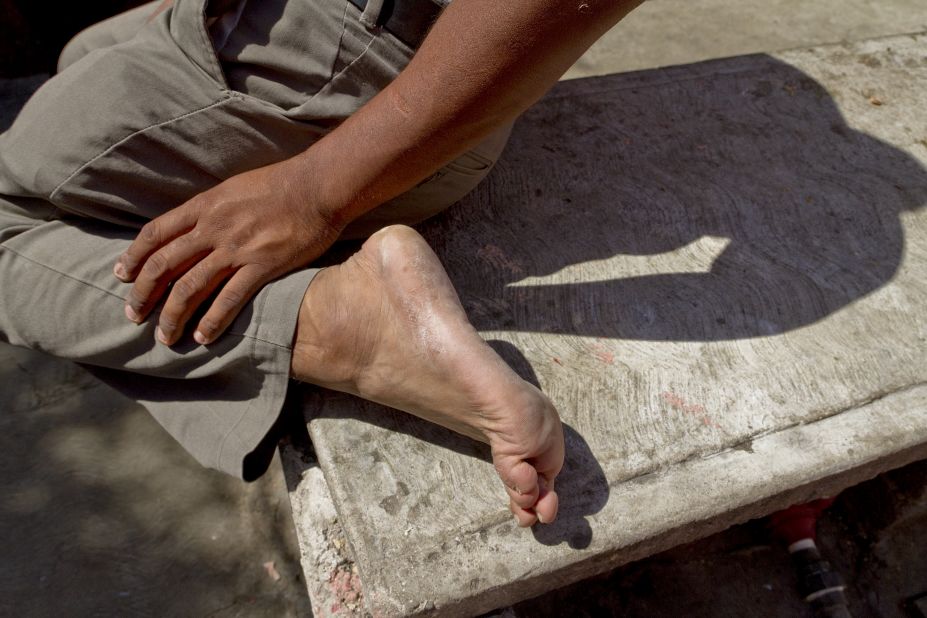 After long treks in harsh conditions, many immigrants arrive with wounds or infections on their feet.