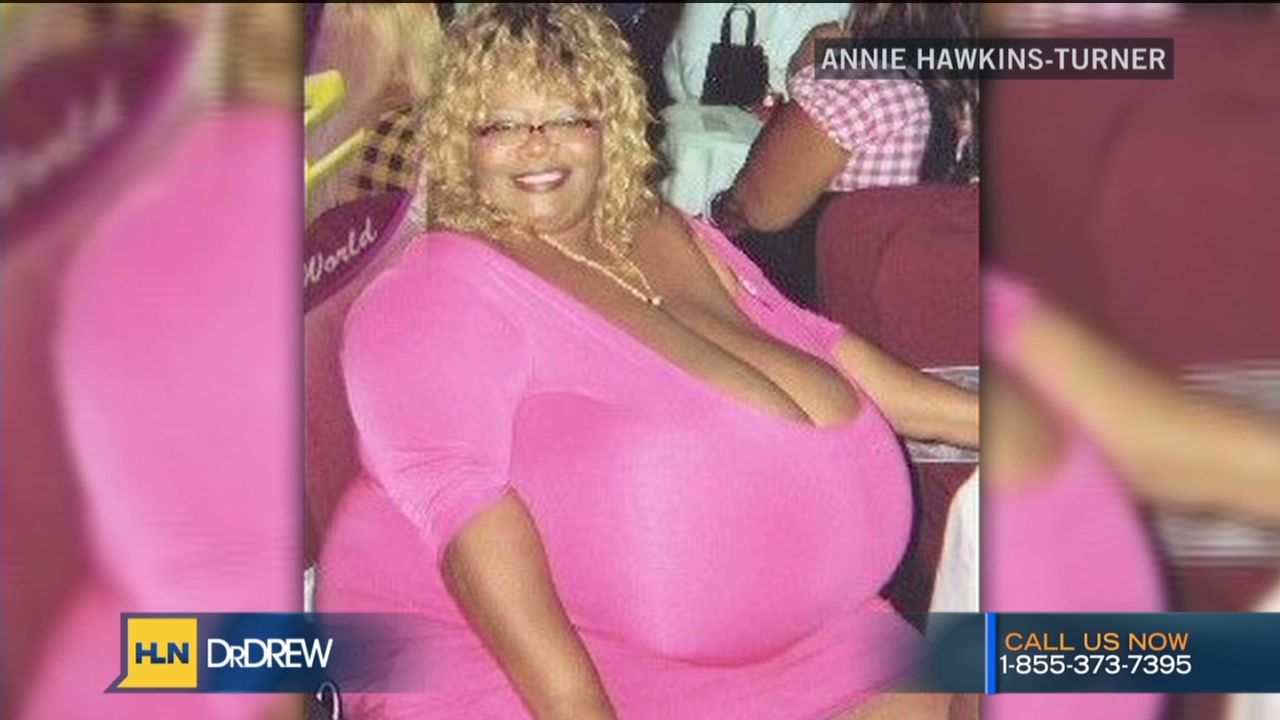 Woman’s breasts weigh 89 pounds CNN