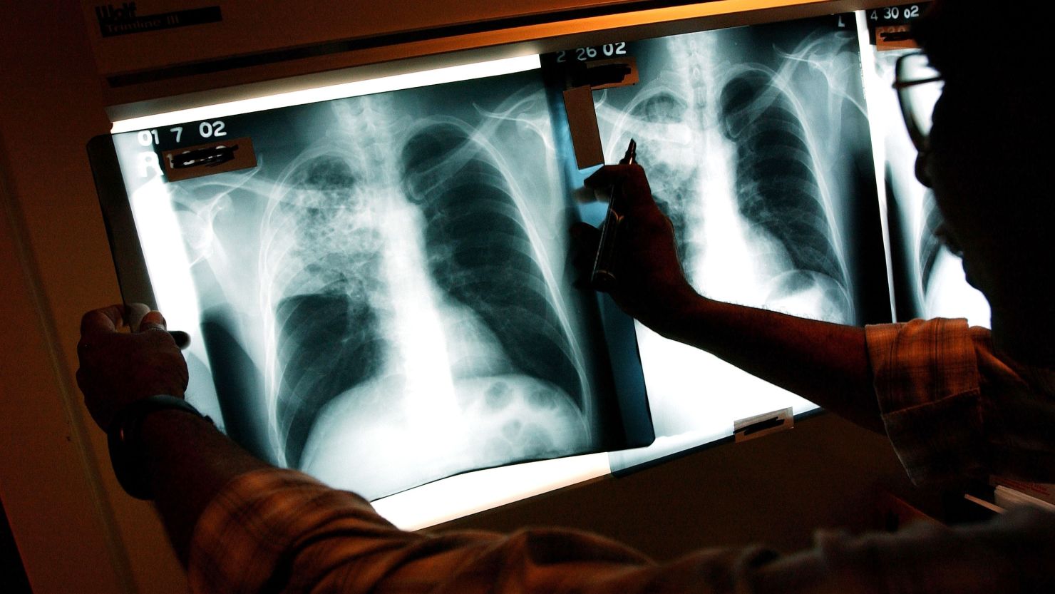 Infant TB exposure under investigation in Nevada | CNN