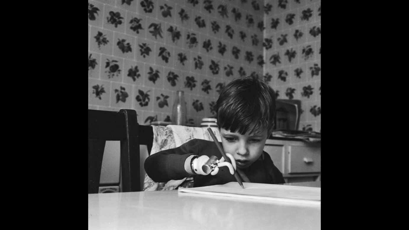 Brett Nielsen, 4, practices writing with his artificial arm in 1964. His birth defect was caused by Thalidomide.