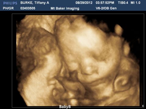 This ultrasound was taken of the twins on August 29. 