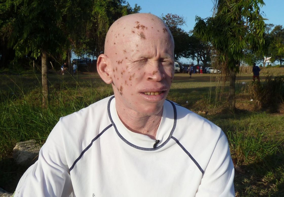 Witchdoctors' belief that albino body parts bring great wealth has led to attacks on people with albinism in western Tanzania. Suleiman Musa works to raise awareness about his genetic condition among Tanzanians.