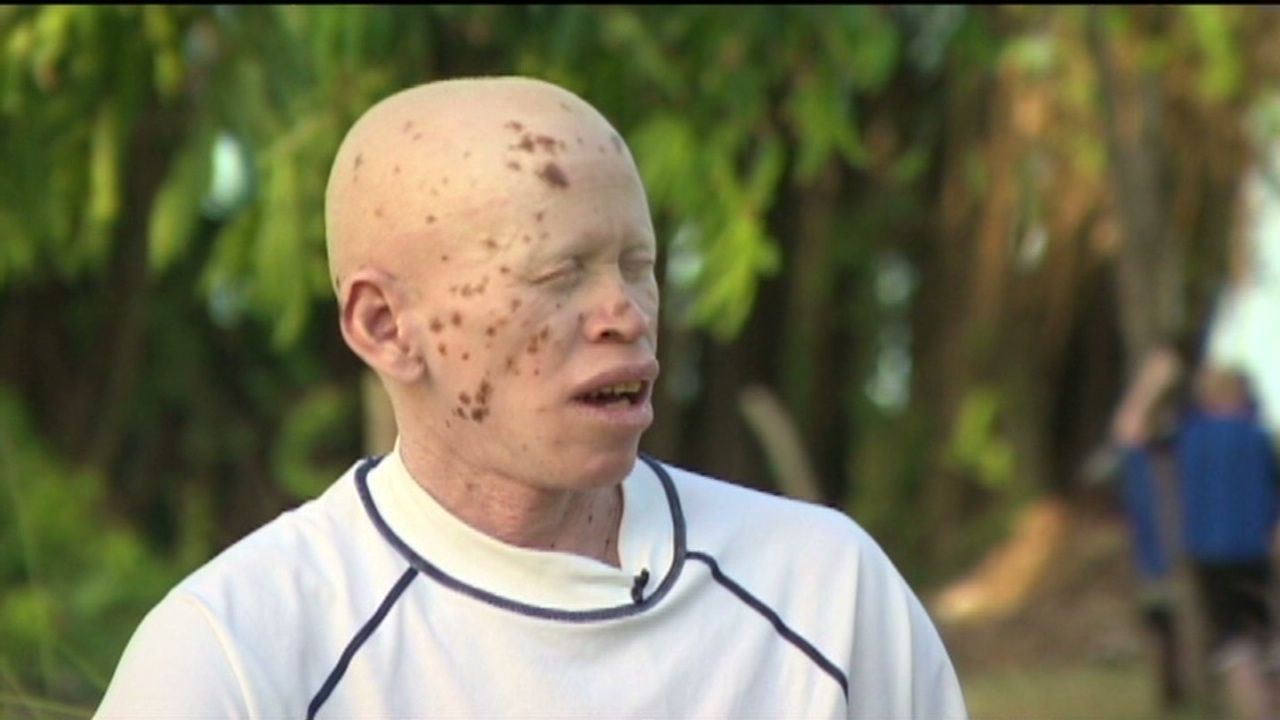 Albinism is a genetic condition that leads to little or no pigment in the eyes, skin and hair.