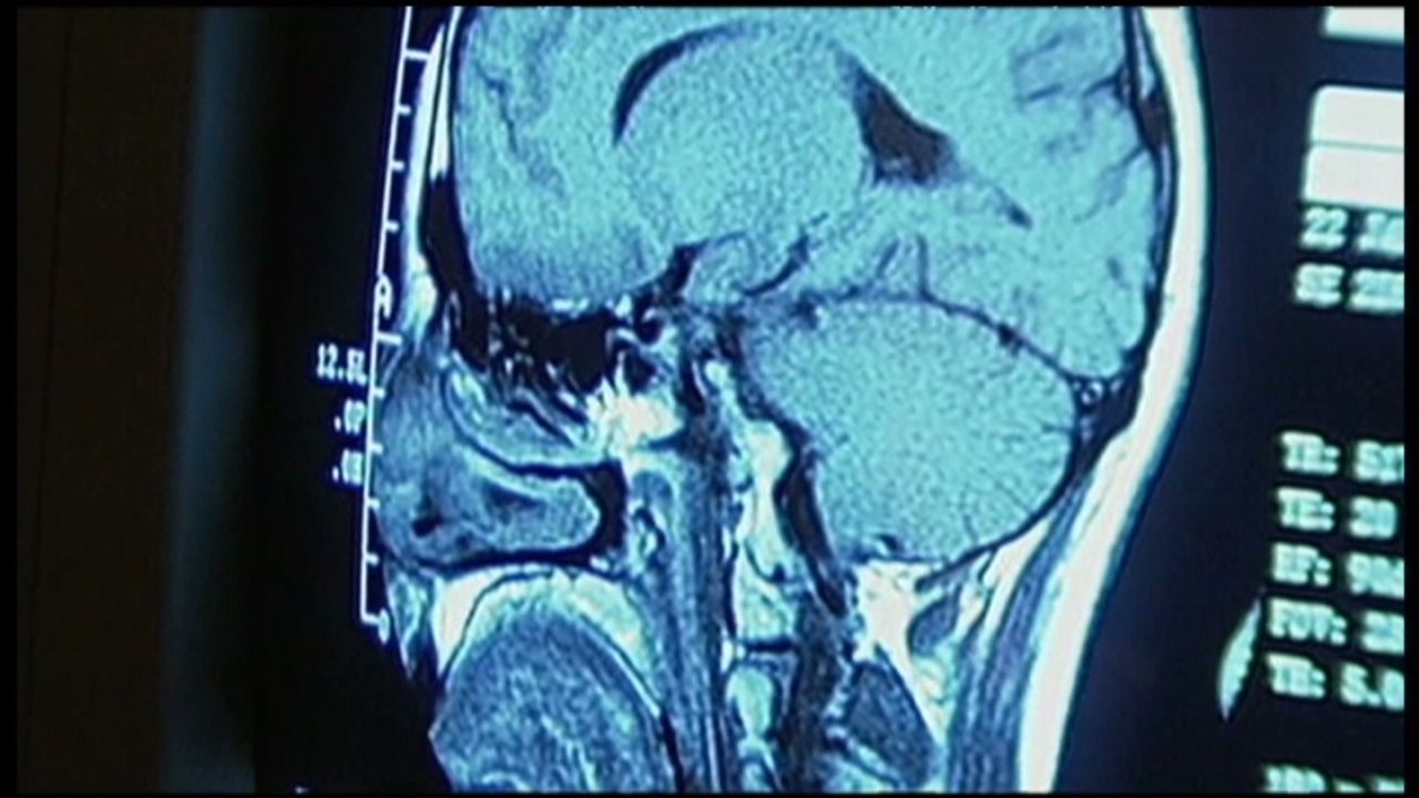 hm fungal meningitis _00005826
