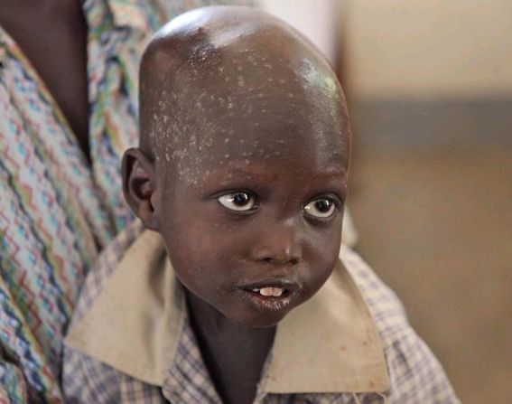 A young child in Juba, South Sudan, in March 2011, who was at a UNICEF supported hospital where he received ready to use fortified food.  