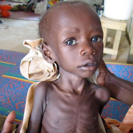 An emaciated child in Eastern Chad in 2006. UNICEF estimates that worldwide around 170 million children under the age of five are stunted. The condition inhibits the development of their bodies and brains.