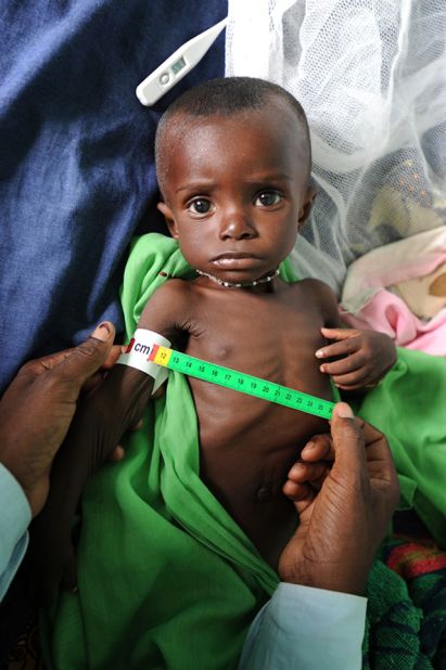 Medical workers at the clinic in Kati, measure the upper arm of Bourama Togo. The result shows that he is suffering from acute malnutrition. 
