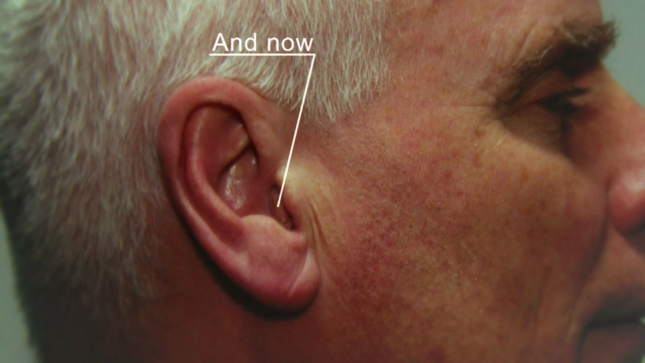 Today, companies like Widex are making hearing aids which are barely noticible, with amplification devices moving from behind to inside the ear.