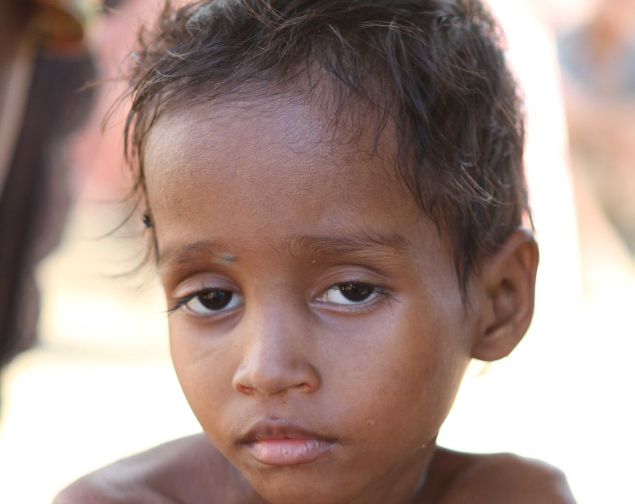 Saulama Hafu is 5 years old and extremely malnourished. There is nothing but rice to eat in the camp. Inadequate diet and terrible sanitary conditions have left her dangerously ill.