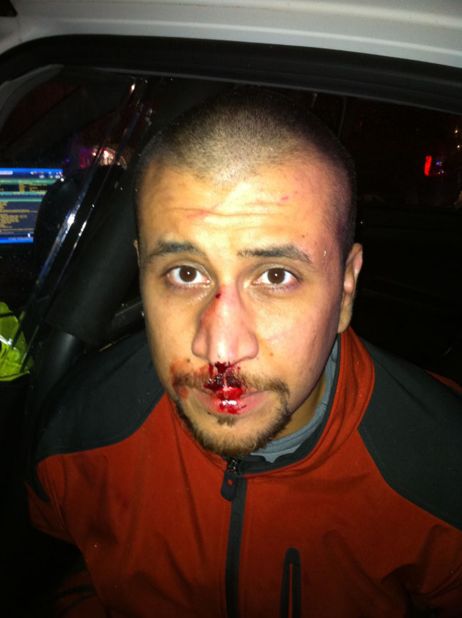 A photo posted online Monday, December 3, shows George Zimmerman with blood on his nose and lips. His attorneys say it was taken the night unarmed teen Trayvon Martin was killed in Sanford, Florida. Zimmerman, 28, faces second-degree murder charges in the death of Martin in Sanford, Florida, on February 26, 2012. Other evidence photos were released earlier this year: 