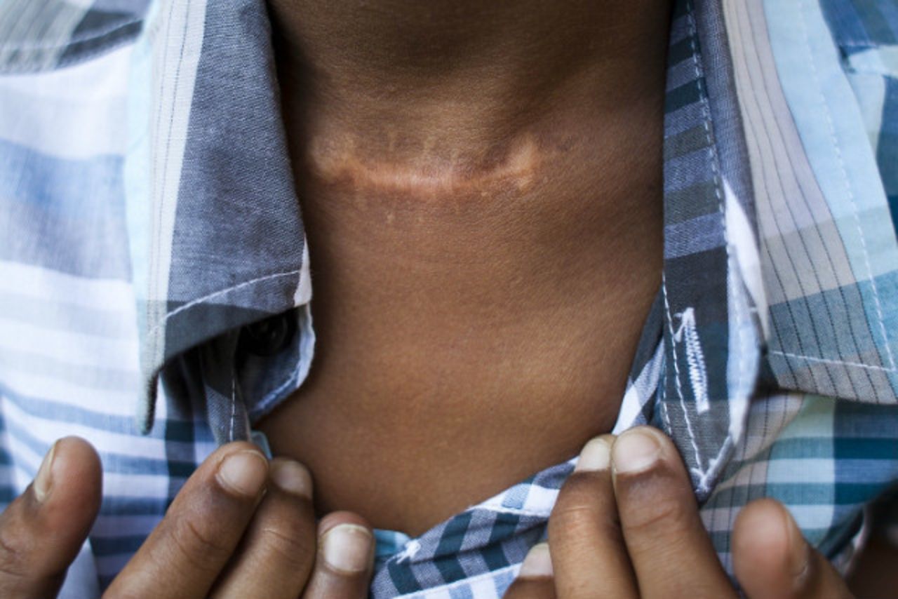 The boy shows the scar on his throat from the 2010 attack.