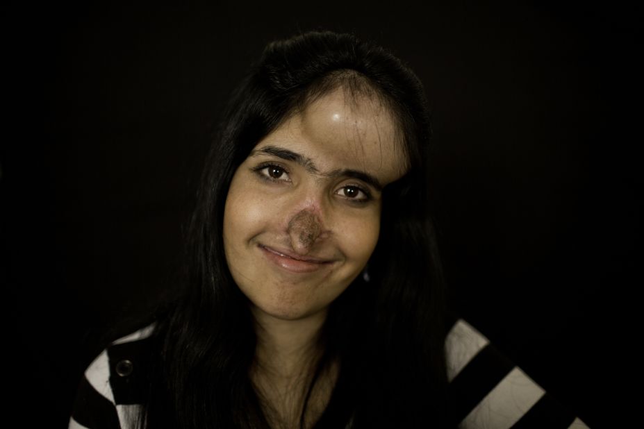 Aesha Mohammadzai is transforming both physically and emotionally. Six months into multistage reconstructive surgery, she's on her way to having the nose she's wanted since she was disfigured and left for dead in Afghanistan. These photos were taken before her latest surgery in December 2012.